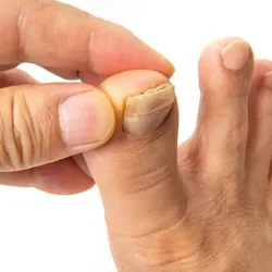 laser toenail fungus removal