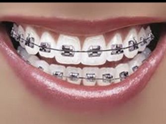 Need braices?  We Offer Start To Finish Orthodontic Treatment At Very Affordable Price 