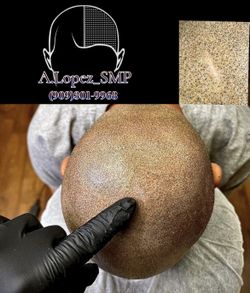 Hair Loss/ Scar Camouflage