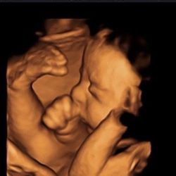 3D 4D Baby Ultrasound