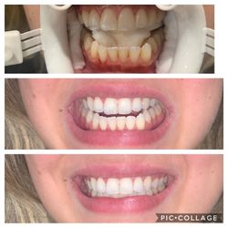 Kit of teeth whitening