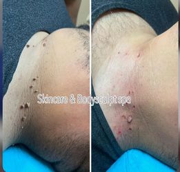 skin Tag, Moles , Wart Removal