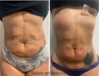 Fibrosis reduction