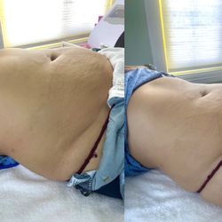 Body Sculpting Radio Frequency CavitationAnd More