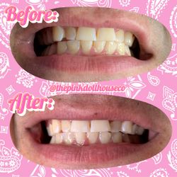 Teeth Whitening, Tooth Gems