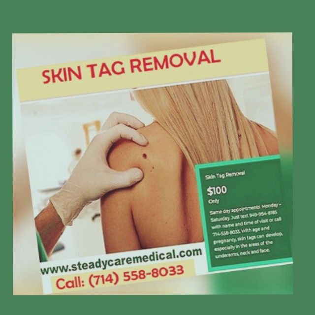 Skin Tag 