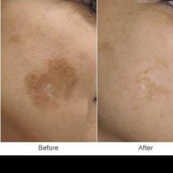 Whitening Soap For Dark Spots