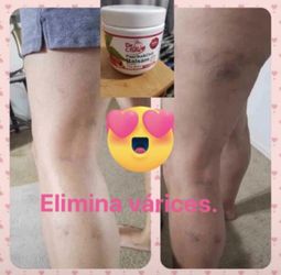 Gel Para Los Dolores Musculares Y La Varices