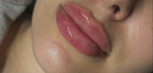 Lip injections/fillers