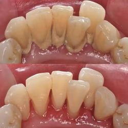 Low Cost Dental Cleanings 