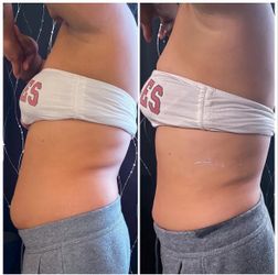 Body Sculpting