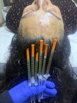 PRP HAIR RESTORATION