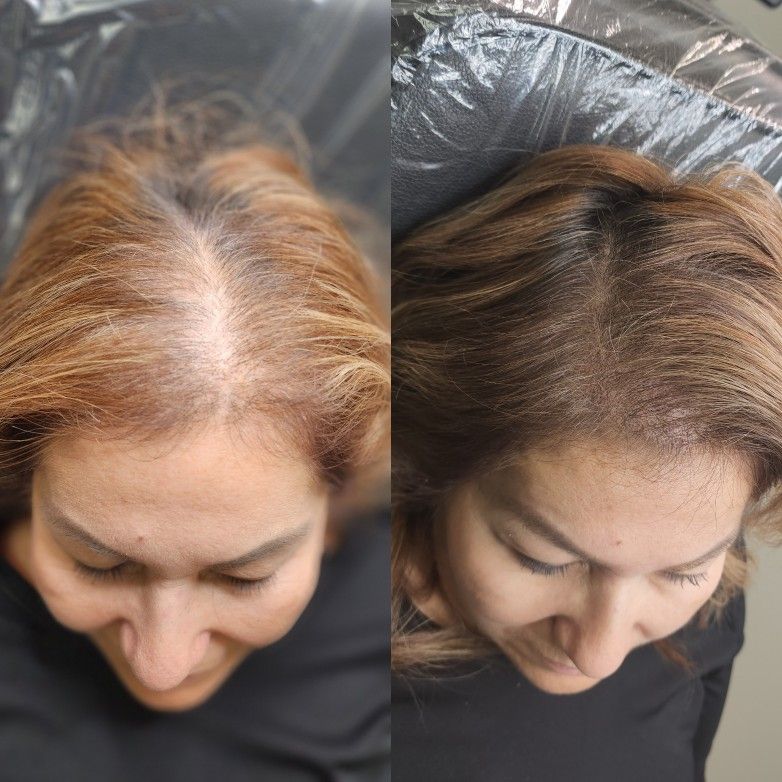 Scalp Cover