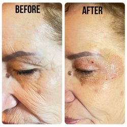 Fibroblasting 