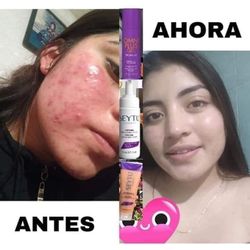 Tratamiento para Acné con Seytú cosmetica