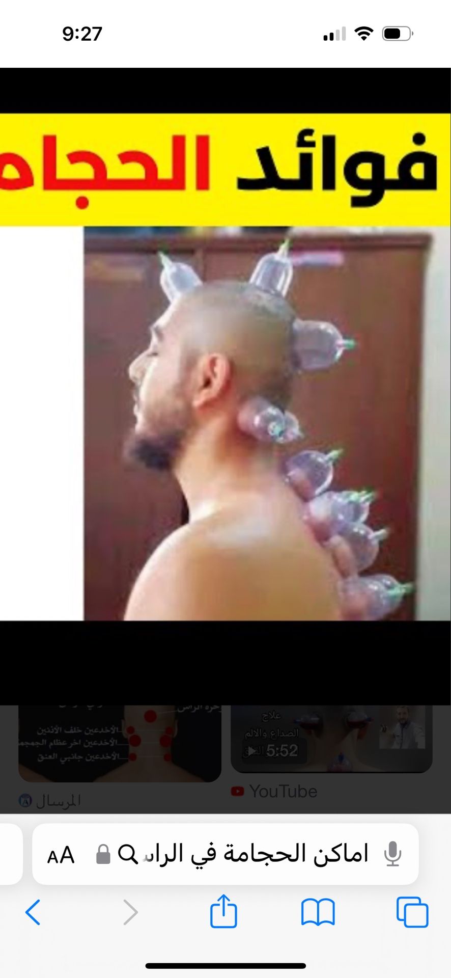 Hijjama / Cupping