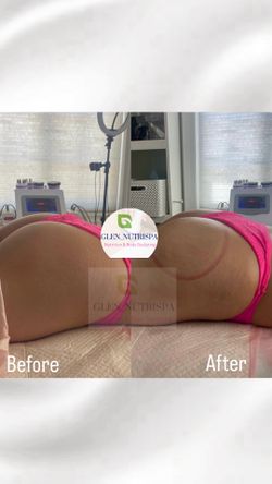 Body Sculpting