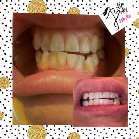 Teeth Whitening