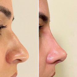 Hyaluronic ACID