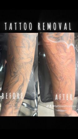 Removal