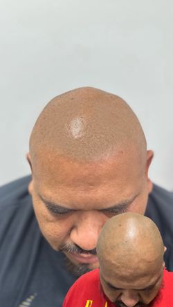 Hairloss Solution 